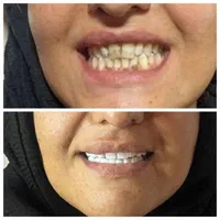 کامپوزیت دندان سفید ترمیم کامپوزیت|خدمات آرایشگری و زیبایی|تهران, ائمه اطهار|دیوار