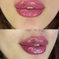 ژل لب چانه گونه بوتاکس فیلرآنزیم بینی لیزرهایفو|خدمات آرایشگری و زیبایی|مشهد, سجاد شهر|دیوار