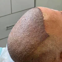 کاشت موی فوق تخصصی