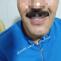 دندان مصنوعی دندانسازی حامد نصیری|خدمات آرایشگری و زیبایی|خرمآباد, |دیوار