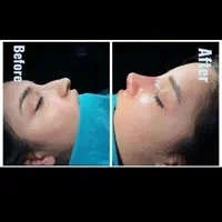 جراحی رینوپلاستی۲۷زیبایی بینی|خدمات آرایشگری و زیبایی|قم, بلوار امین و ساحلی|دیوار