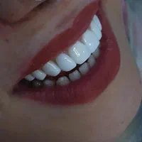 ایمپلنت کامپوزیت سفید کردن جرمگیری دندانپزشکی|خدمات آرایشگری و زیبایی|کرج, اصفهانی‌ها|دیوار