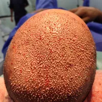 جذب تکنسین کاشت مو|استخدام درمانی، زیبایی، بهداشتی|شیراز, قدوسی غربی|دیوار