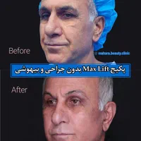 جشنواره جوانسازی Max Lift پزشک پوست مو بینی زیبایی|خدمات آرایشگری و زیبایی|مشهد, هفت تیر (حافظ)|دیوار