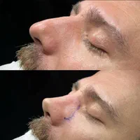 جراحی بینی  لیپوماتیک  پروتز سینه ابدو مامو لیفت|خدمات آرایشگری و زیبایی|اصفهان, مرداویج|دیوار