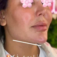 فیلر چانه گونه کانتورینگ زاویه ژل لب بوتاکس شیدینگ|خدمات آرایشگری و زیبایی|فردیس, |دیوار