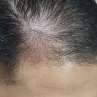پاکسازی پوست(فیشال) پاکسازی کف سر(اسکراب اسکالپ)|خدمات آرایشگری و زیبایی|شیراز, عفیف‌آباد|دیوار