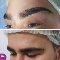 بوکالفت/ساکشن غبغب/ساکشن شکم/تزریق چربی باسن/فیلر|خدمات آرایشگری و زیبایی|تهران, صادقیه|دیوار