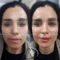 تزریق ژل (فیلر)وبوتاکس لیفت با نخ‌ مادلینگ درشرق|خدمات آرایشگری و زیبایی|تهران, نارمک|دیوار