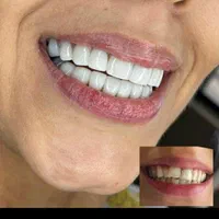 آفرلمینت‌دندان‌وروکش|خدمات آرایشگری و زیبایی|تهران, شهرک ولیعصر جنوبی|دیوار