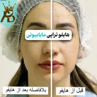 جوانسازی قوی  لیفت صورت ،روشن کننده هایفوتراپی|خدمات آرایشگری و زیبایی|یاسوج, |دیوار