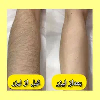 کلینیک تخصصی لیزر موهای زائد(الکساندرایت آمریکای)|خدمات آرایشگری و زیبایی|خرمشهر, |دیوار