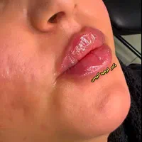بوتاکس مصپورت فقط۴۹۰ کلینیک زیبایی دکتر فرشیدکریمی|خدمات آرایشگری و زیبایی|کرمانشاه, |دیوار