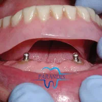 دندانپزشکی تخصصی ایمپلنت پیوند استخوان /اقساط|خدمات آرایشگری و زیبایی|تهران, پونک|دیوار
