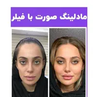 فیلرژل بوتاکس پی ارپی لاغر تزریق چربی مزولیزرهایفو