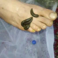طب سنتی زالو درمانی و حجامت