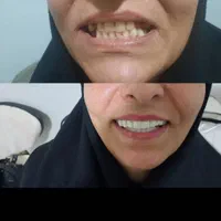 کامپوزیت متحرک دندان فوری|خدمات آرایشگری و زیبایی|مشهد, جانباز|دیوار