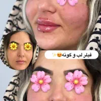 تزریق و آموزش انواع فیلرو بوتاکس|خدمات آرایشگری و زیبایی|مشهد, فرهنگیان (شهرک غرب)|دیوار