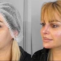 اصلاح فرم صورت.جوانسازی به روش یانگ فیس توسط متخصص|خدمات آرایشگری و زیبایی|مشهد, سناباد|دیوار