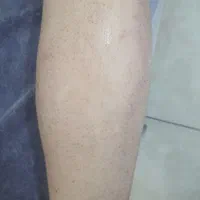 خدمات لیزر مردانه با دو دستگاه پیشرفته 2025|خدمات آرایشگری و زیبایی|تهران, یافت آباد جنوبی|دیوار