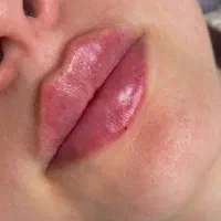 تزیق ژل و بوتاکس با۵۰ درصد تخفیف درجشنواره ویژه