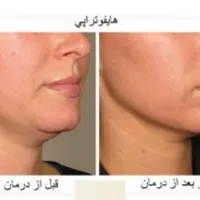 هایفوتراپی لیفت صورت رفع غبغب|خدمات آرایشگری و زیبایی|تهران, میرداماد|دیوار