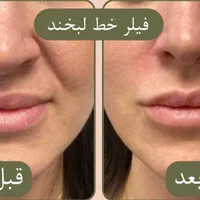 جشنواره بوتاکس،فیلر،‌لب روسی،جوانسازی،توسط پزشک|خدمات آرایشگری و زیبایی|زنجان, |دیوار