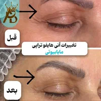 جوانسازی قوی  لیفت صورت ،روشن کننده هایفوتراپی|خدمات آرایشگری و زیبایی|یاسوج, |دیوار