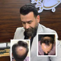 کاشت مو ، تراکم بالا خط رویش طبیعی تضمینی|خدمات آرایشگری و زیبایی|تهران, عباس‌آباد|دیوار