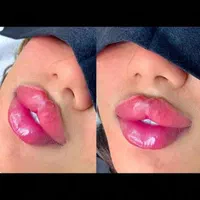 تزریق ژل بوتاکس،هایفو مزوتراپی توسط پزشک|خدمات آرایشگری و زیبایی|کرج, گوهردشت|دیوار