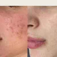 جوش و تیرگی صورت ، ریزش مو ، جوانسازی پوست|خدمات آرایشگری و زیبایی|رفسنجان, |دیوار