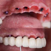 دندانپزشکی/ایمپلنت/اقساطی/زیبایی/کامپوزیت|خدمات آرایشگری و زیبایی|تبریز, |دیوار