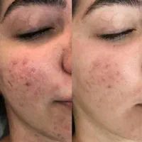 فیشیال تخصصی پوست|خدمات آرایشگری و زیبایی|سبزوار, فرهنگیان|دیوار