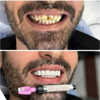 آفرلمینت‌دندان‌وروکش|خدمات آرایشگری و زیبایی|تهران, شهرک ولیعصر جنوبی|دیوار