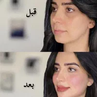 جشنواره بهاره ژل و بوتاکس آنزیم لیزر مزوتوسط پزشک|خدمات آرایشگری و زیبایی|کرج, جهان‌شهر|دیوار