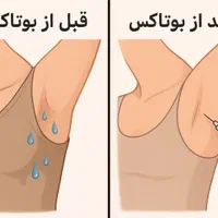 بوتاکس زیر بغل در منزل شما|خدمات آرایشگری و زیبایی|تهران, باغ فیض|دیوار