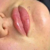 جشنواره فیلر ژل لب چال لپ کاشت نگین دندان پیرسینگ|خدمات آرایشگری و زیبایی|زنجان, |دیوار