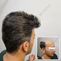 ترمیم مو /پروتز مو  / جایگزین کاشت مو و کلاهگیس|خدمات آرایشگری و زیبایی|اصفهان, آبشار|دیوار