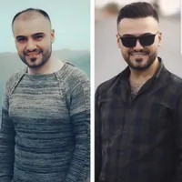 مرکز کاشت مو آتیه یزد