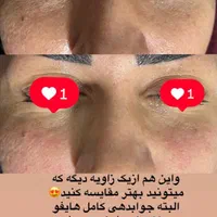 لیزر co2 فراکشنال و هایفوی پزشکی نه رومیزی|خدمات آرایشگری و زیبایی|اهواز, کیانپارس |دیوار