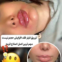 تزریق ژل و بوتاکس و فیشال تخصصی توسط پزشک|خدمات آرایشگری و زیبایی|برازجان, |دیوار