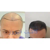 کاشت مو فول تراکم|خدمات آرایشگری و زیبایی|تهران, نارمک|دیوار