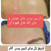تزریق چربی صورت،ژل،بوتاکس،لیزر،لاغری|خدمات آرایشگری و زیبایی|رشت, گلسار|دیوار