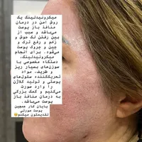 آموزش مزونیدلینگ و بوتاکس|خدمات آرایشگری و زیبایی|کوهدشت, |دیوار