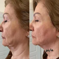 هایفو تراپی جوانسازی قرن نوین
