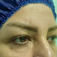 (شوش، شوشتر، اندیمشک) بلفاروپلاستی|خدمات آرایشگری و زیبایی|شوش, |دیوار