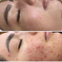 درمان مشکلات پوست مطب/مزوتراپی/فشیال/مزونیدلینگ/ژل|خدمات آرایشگری و زیبایی|مشهد, دانشجو|دیوار