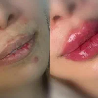 تزریق ژل فیلر بوتاکس مزوژل|خدمات آرایشگری و زیبایی|مشهد, طبرسی شمالی|دیوار