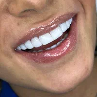 دندانپزشکی.کامپوزیت دندان .عصب کشی .لمینت.روکش|خدمات آرایشگری و زیبایی|تهران, تهرانپارس شرقی|دیوار
