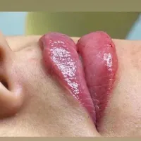 بوتاکس، ژل، چربی، لیزر، هایفوتراپی توسط پزشک|خدمات آرایشگری و زیبایی|یزد, |دیوار